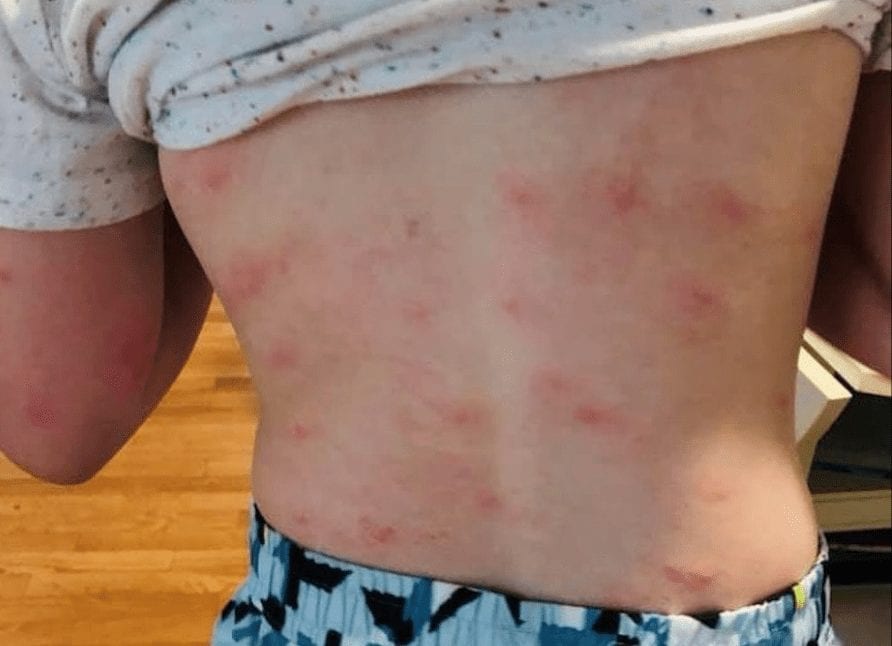 Update All Hingham Beaches Open Hingham Anchor